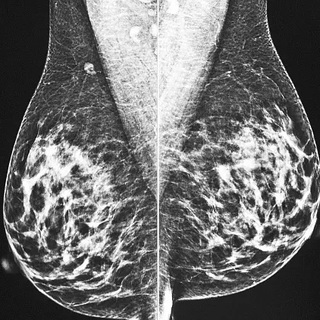 Drasztikusan nő a rák kockázata az 50 év alattiak között