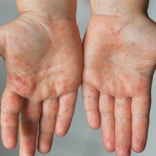 A népegészségügyi központ szerint a magyar lakosság védett a kanyaró ellen