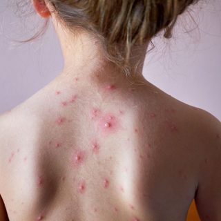 Kanyarójárvány van Belgrádban