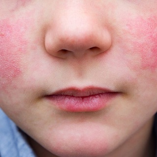 Terjed a lepkehimlő az óvodások között