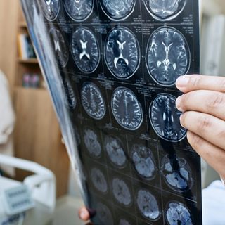 Több százmillió forintból kidolgozott tesztsorozat segíti az Alzheimer-kór korai diagnosztizálását